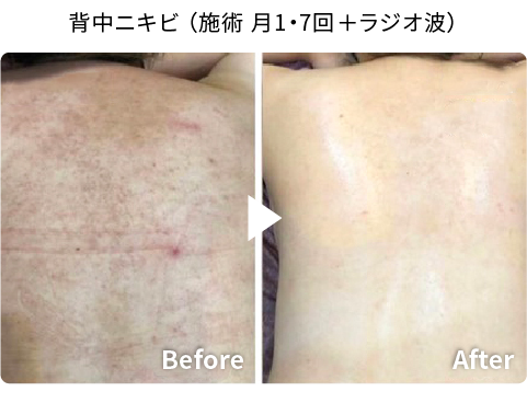 背中ニキビBefore After（施術 月1・7回＋ラジオ波）